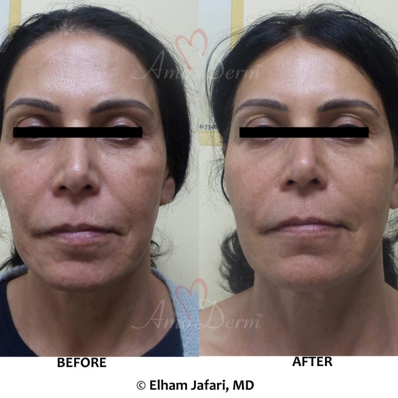 Chemical Peel (VI Peel) for skin rejuvenation and treatment of fine lines and skin pigmentation (dark or brown spots)