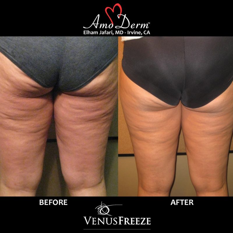 Body Contouring and Cellulite Treatment