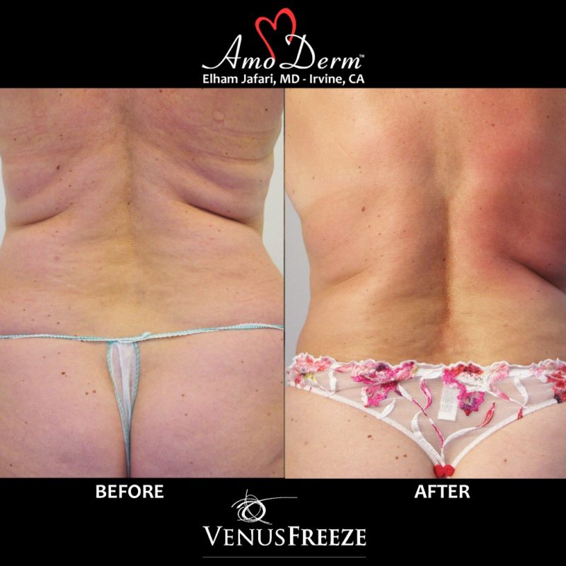 Body contouring and cellulite treatment with Venus Freeze