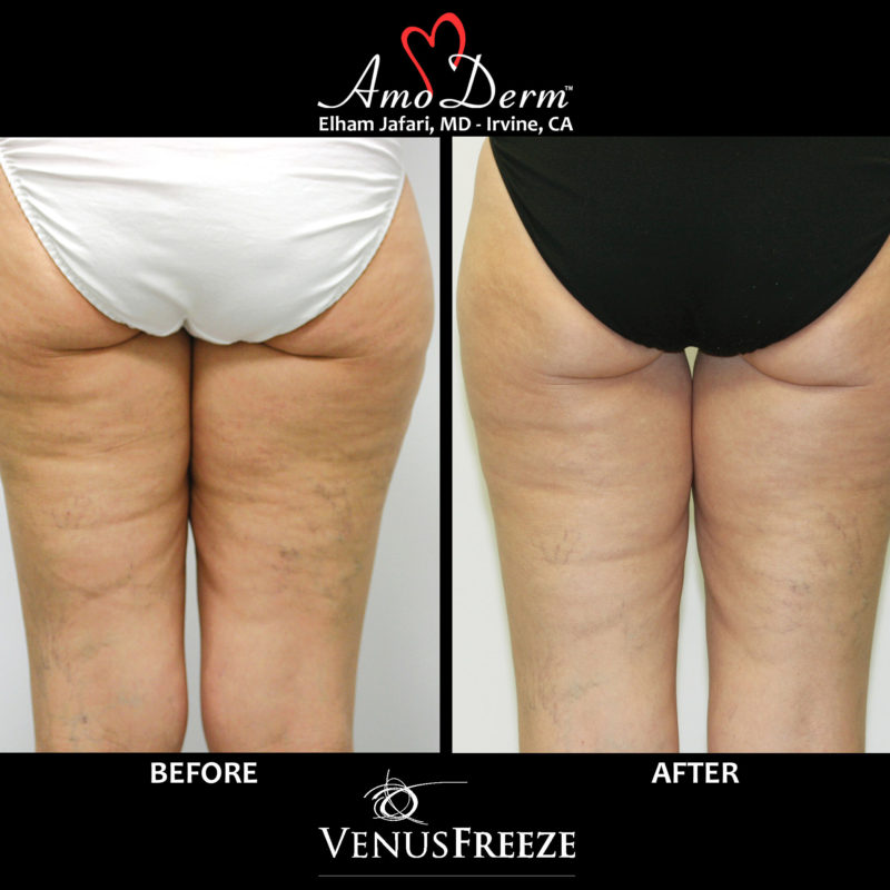 Venus Freeze