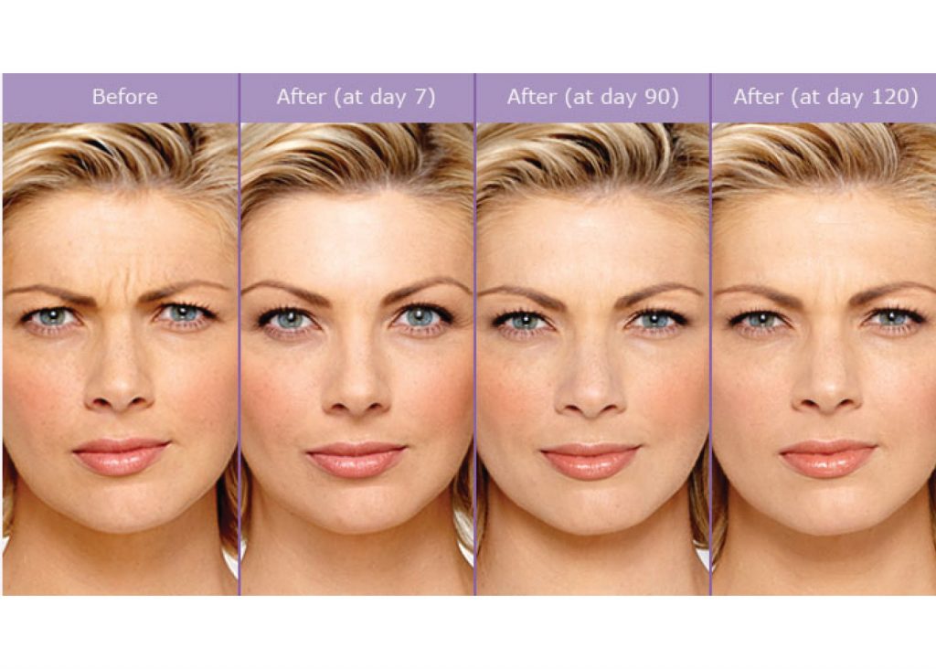 botox rejuvenating efect lines wrinkles