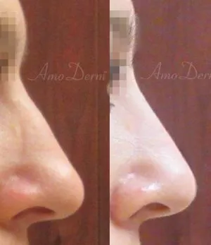 Nonsurgical Nose Job Treatment