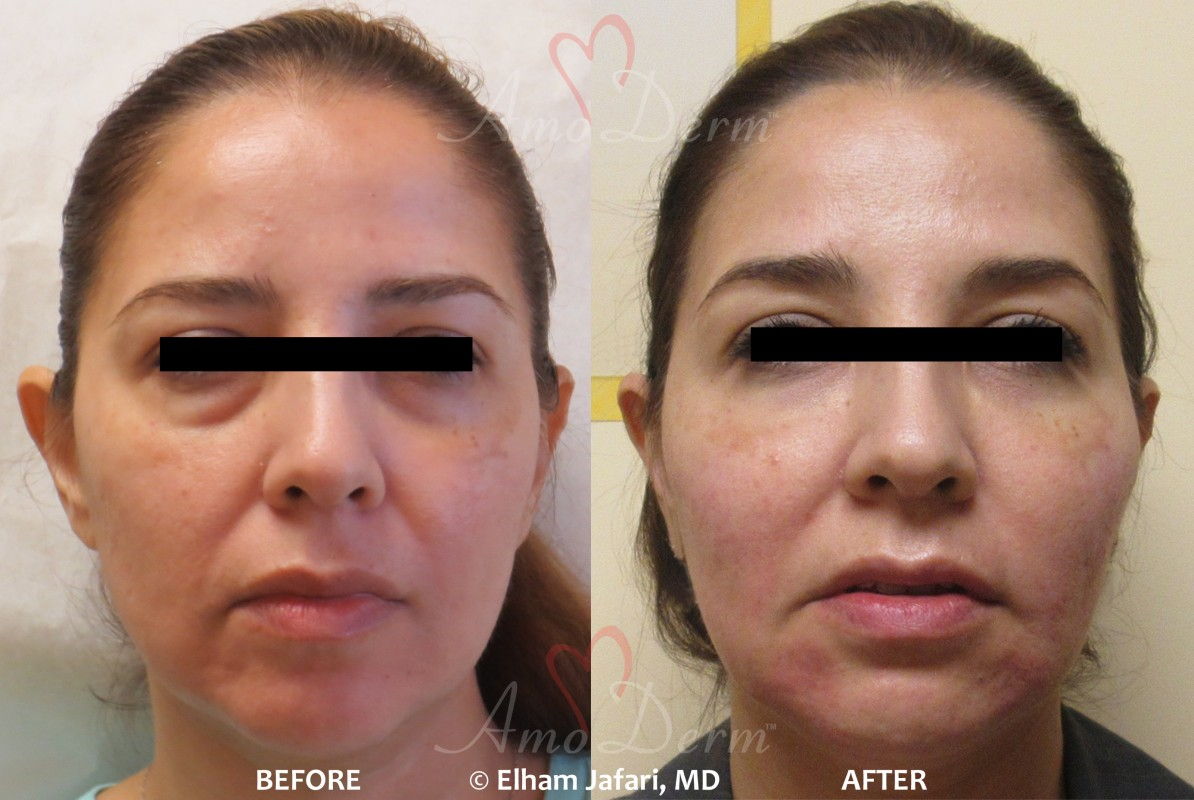 Bellafill dermal fillers injection before and after pictures