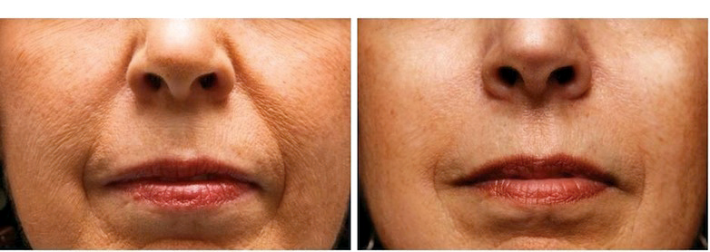 Bellafill Aesthetic Woman Mouth Before and After