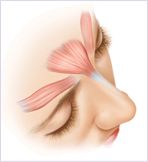 Botox in Irvine, California