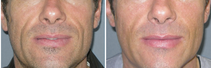 Bellafill Around Men Mouth Before and After