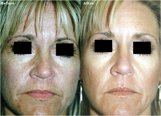 Fractional CO2 Laser Treatment - before and after pictures with real patients