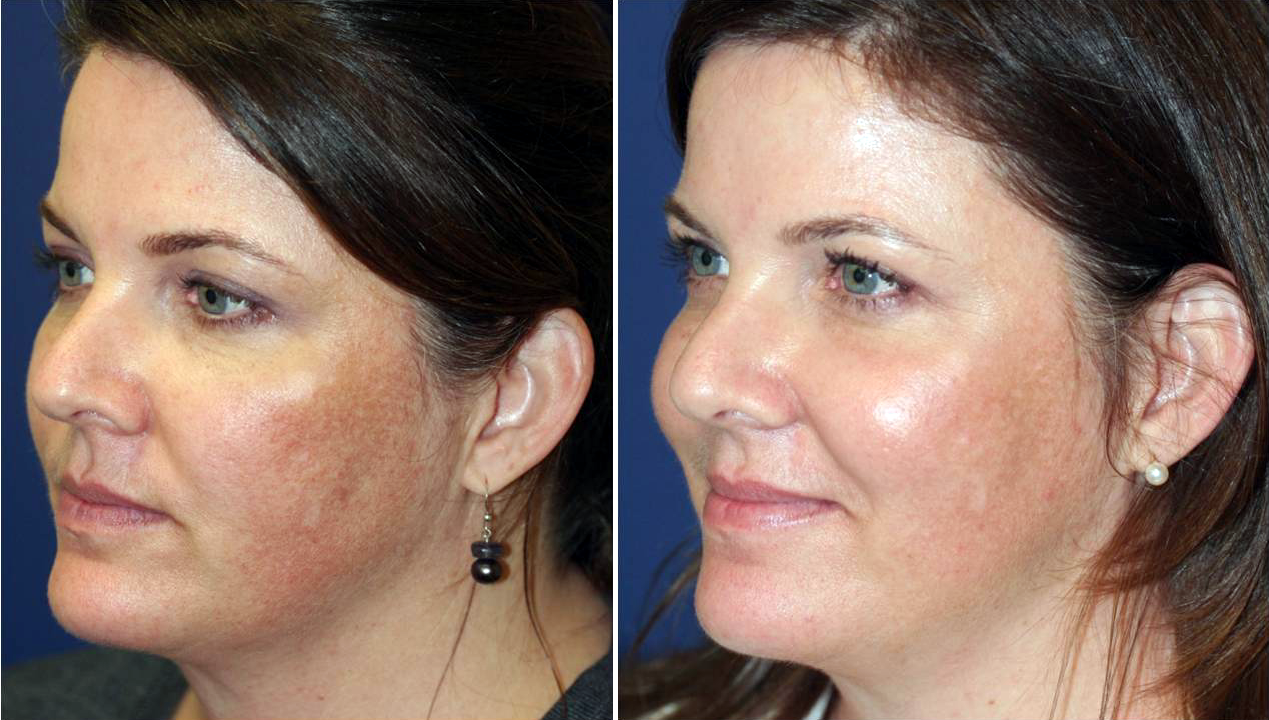 Fractional CO2 Laser Resurfacing Irvine & Orange County