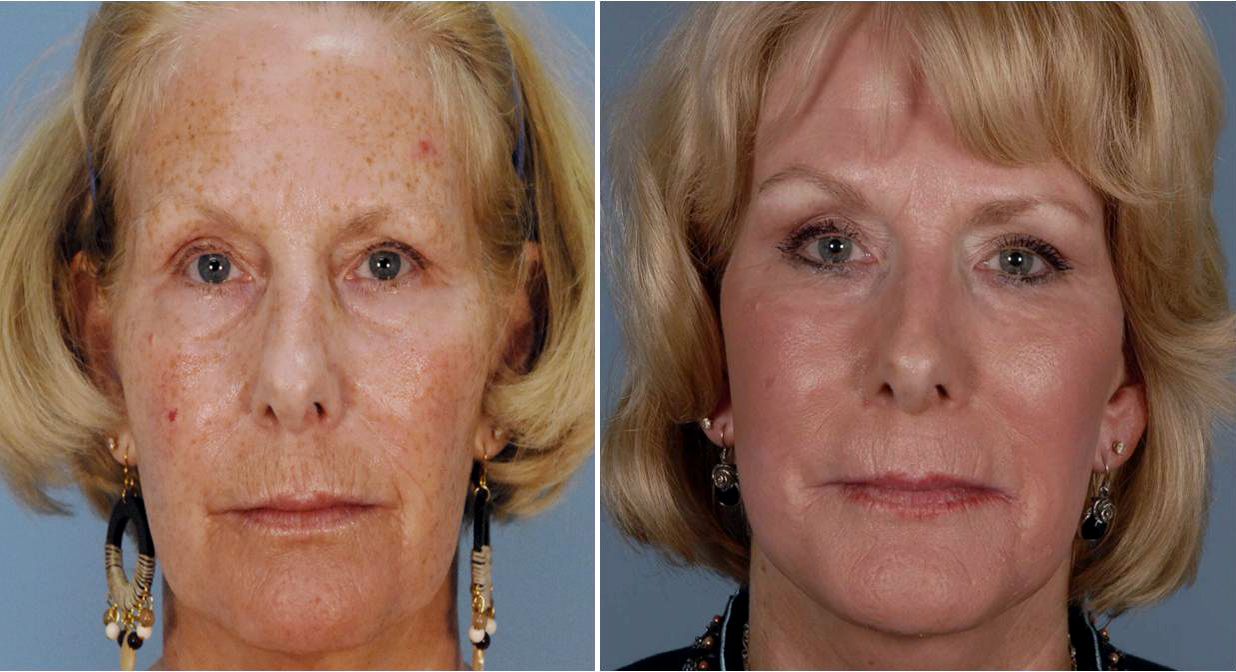 CO2 Laser Facial Rejuvenation: Fix Fine Lines, Wrinkles, Sun Damage &  Stretch Marks