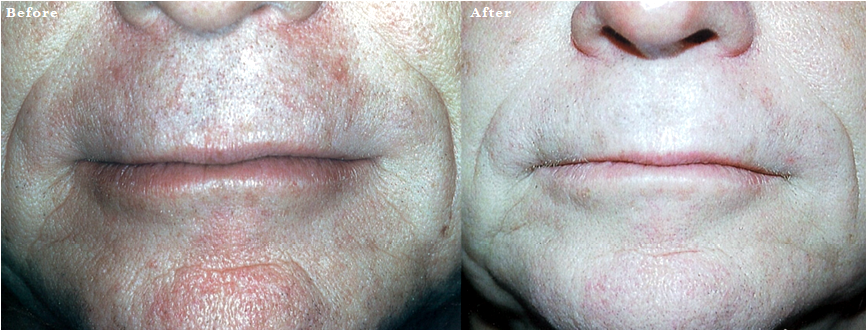 What is the Difference between Fractional CO2 and Erbium Laser Skin Resurfacing