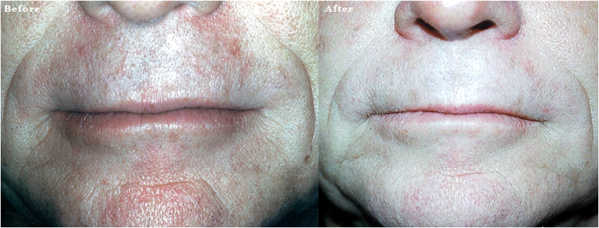 Fractional CO2 Laser Resurfacing Irvine & Orange County