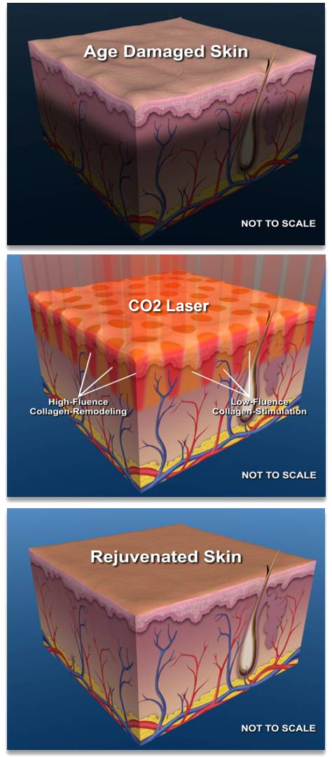 Fractional CO2 Laser, Fraxel & ProFractional in Irvine