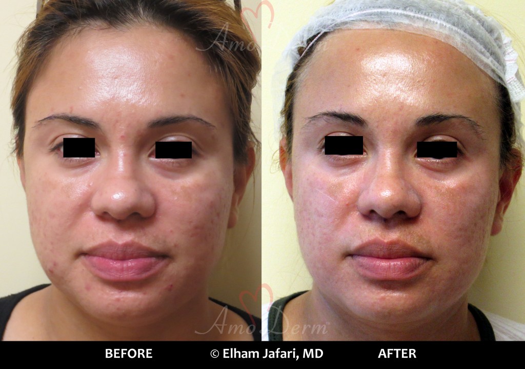 Fractional CO2 Laser Treatment - before and after pictures with real patients