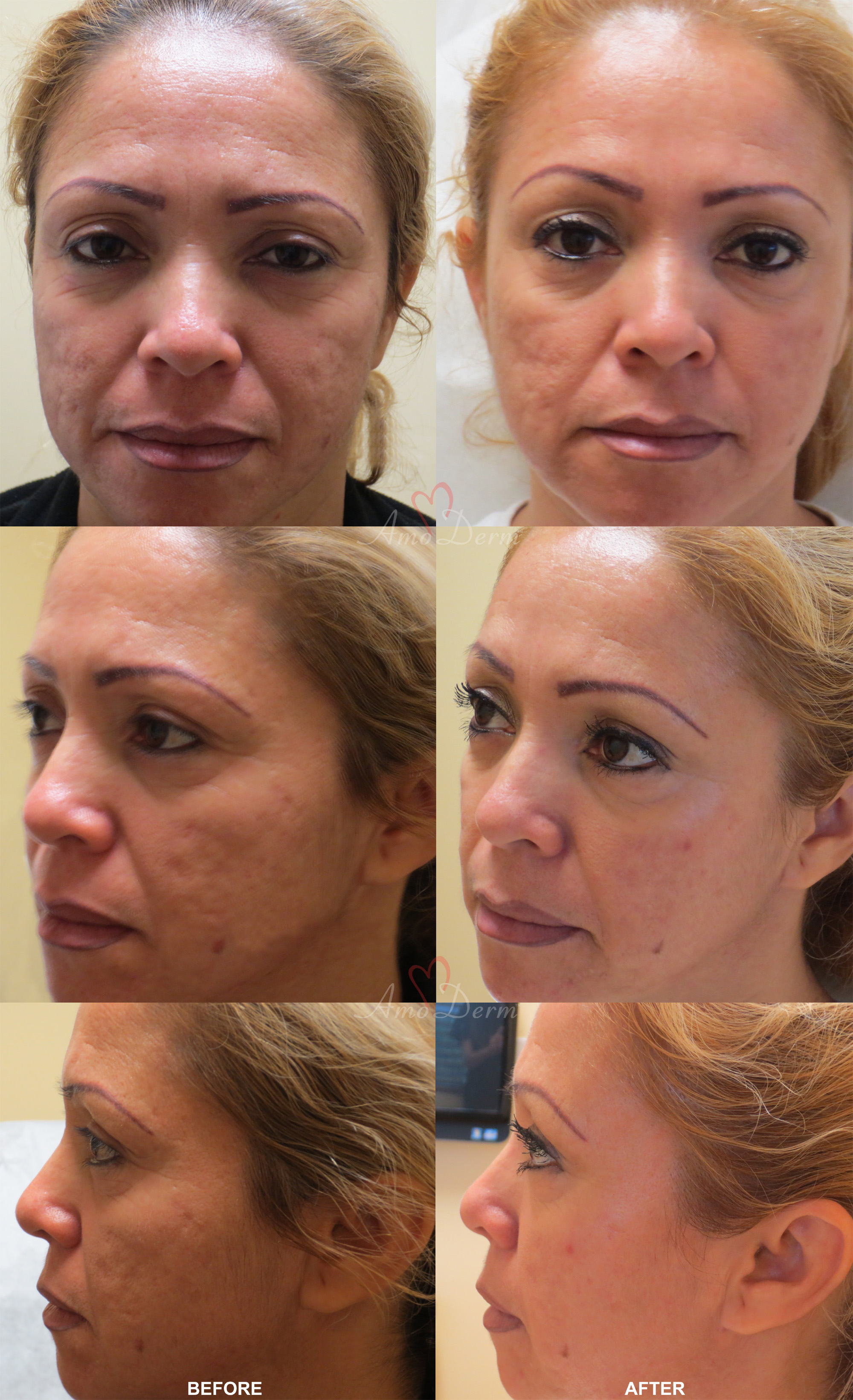 Fractional CO2 Specialist - Irvine, CA: Cosmetic Laser Center of