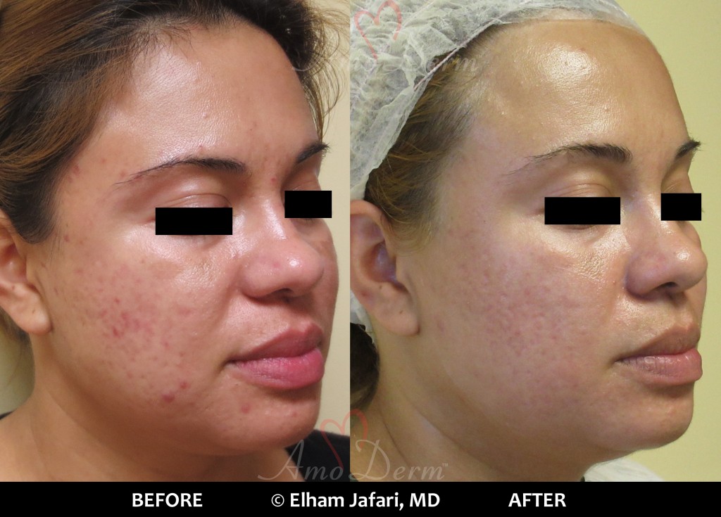 Fractional CO2 Laser Before and After Photos