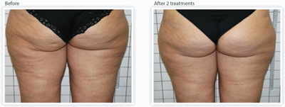 Cellulite Reduction in Orange County, California