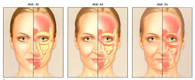 Facial fat loss as seen during aging