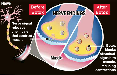 How Botox Works