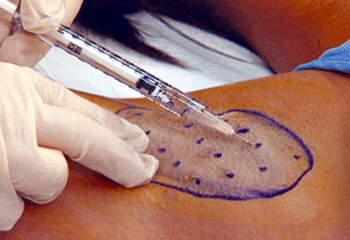 Hyperhidrosis (excessive sweating) Treatment in Orange County