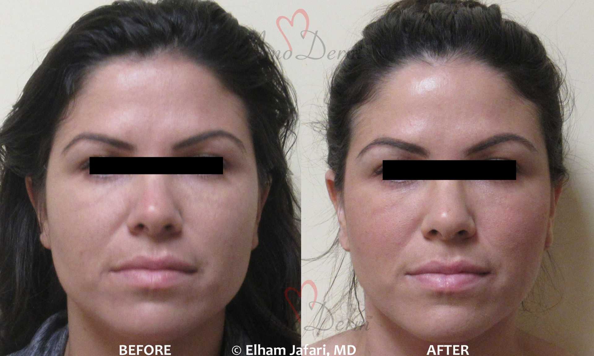 Jaw Slimming Treatment - Before and After picture
