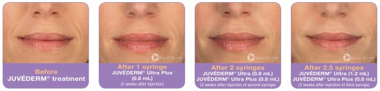 Juvederm before and after photos