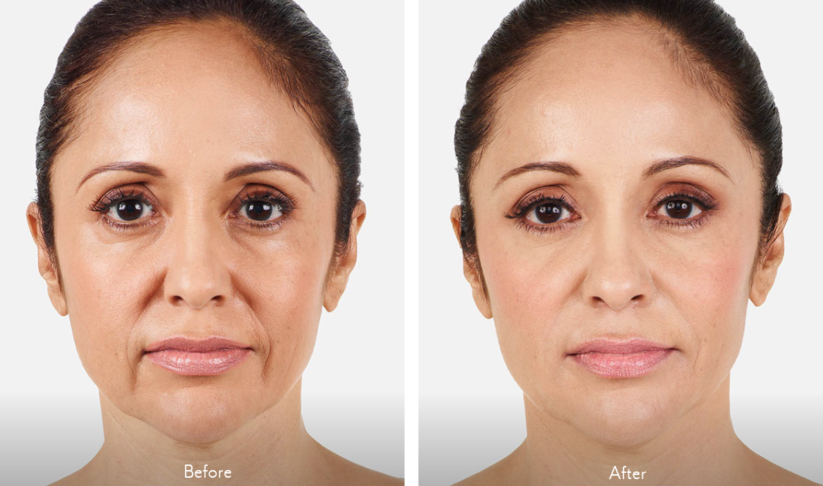 Juvederm Vollure - before and after