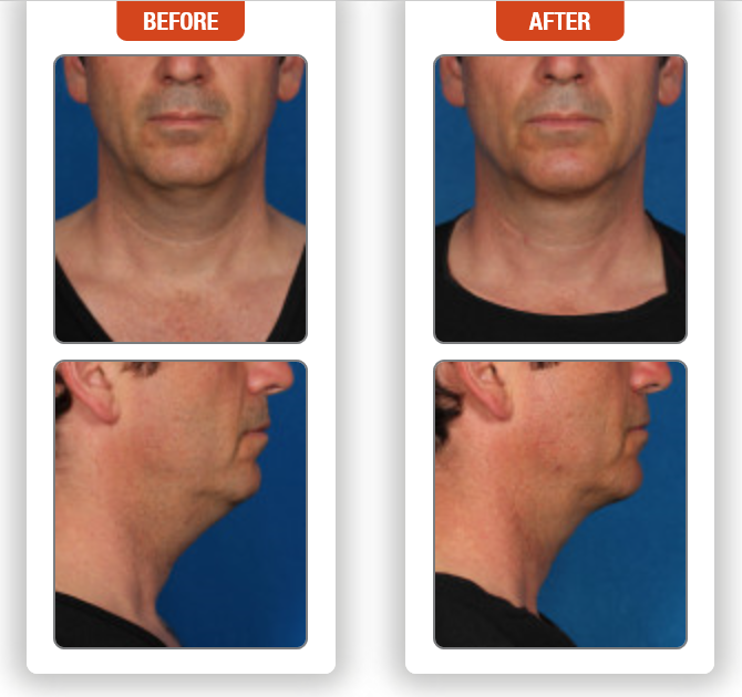 Kybella Injection for under the Chin and upper Neck- Before and After Pictures