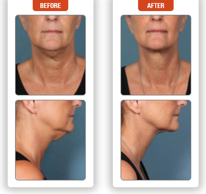 Kybella Injection for under the Chin and upper Neck- Before and After Pictures
