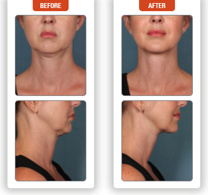 Kybella Injection for under the Chin and upper Neck- Before and After Pictures