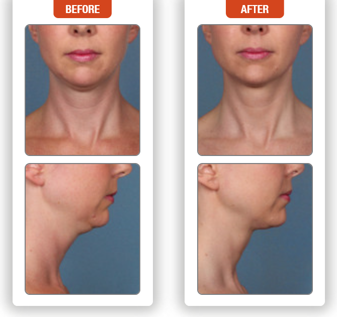 Kybella Injection for under the Chin and upper Neck- Before and After Pictures