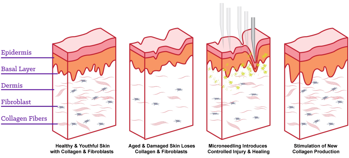 Micro Needling