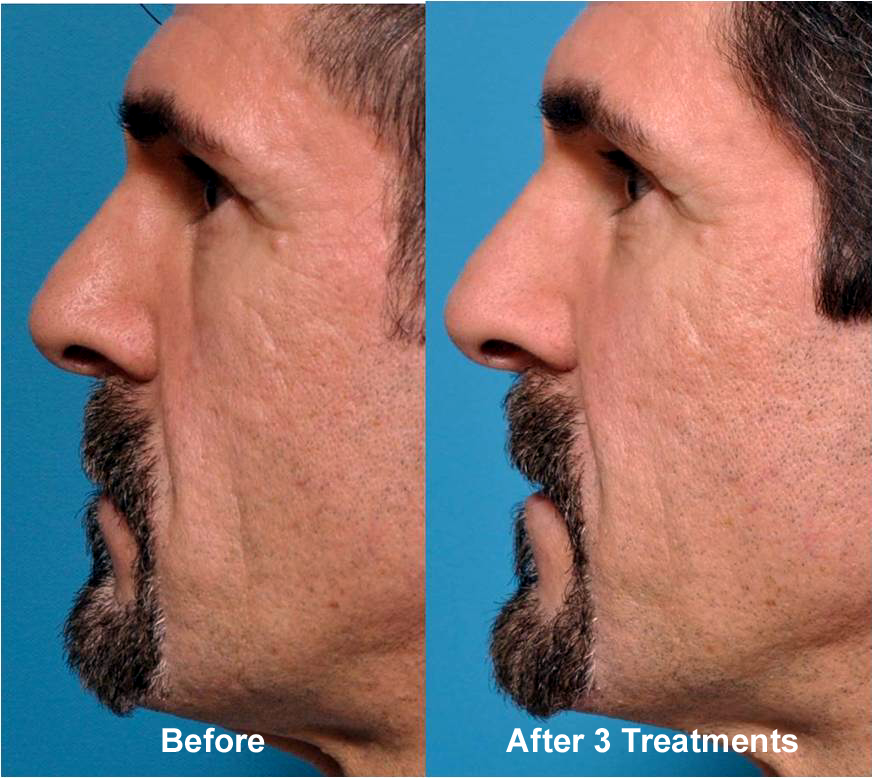 Micro Needling - Before and After Cosmetic Treatments pictures