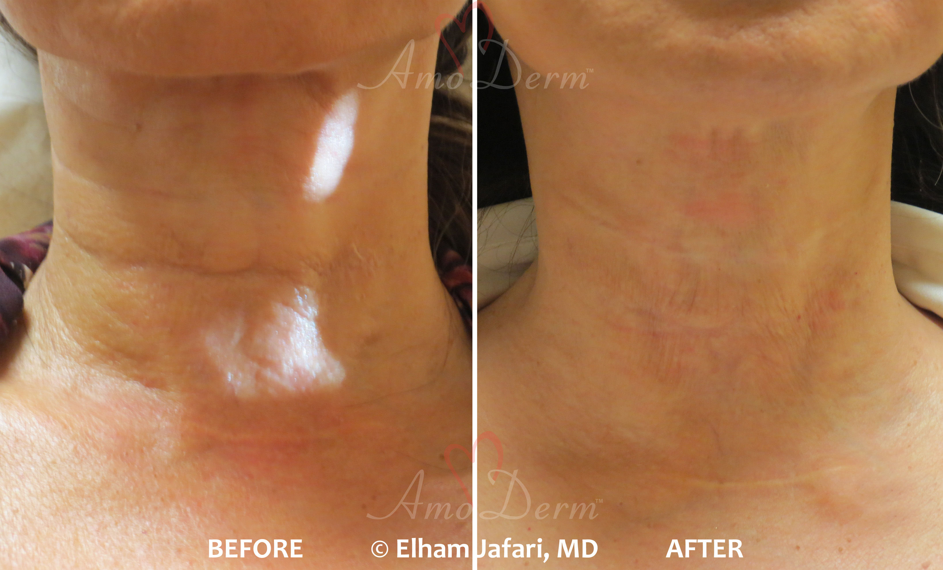 NeckRejuvenation