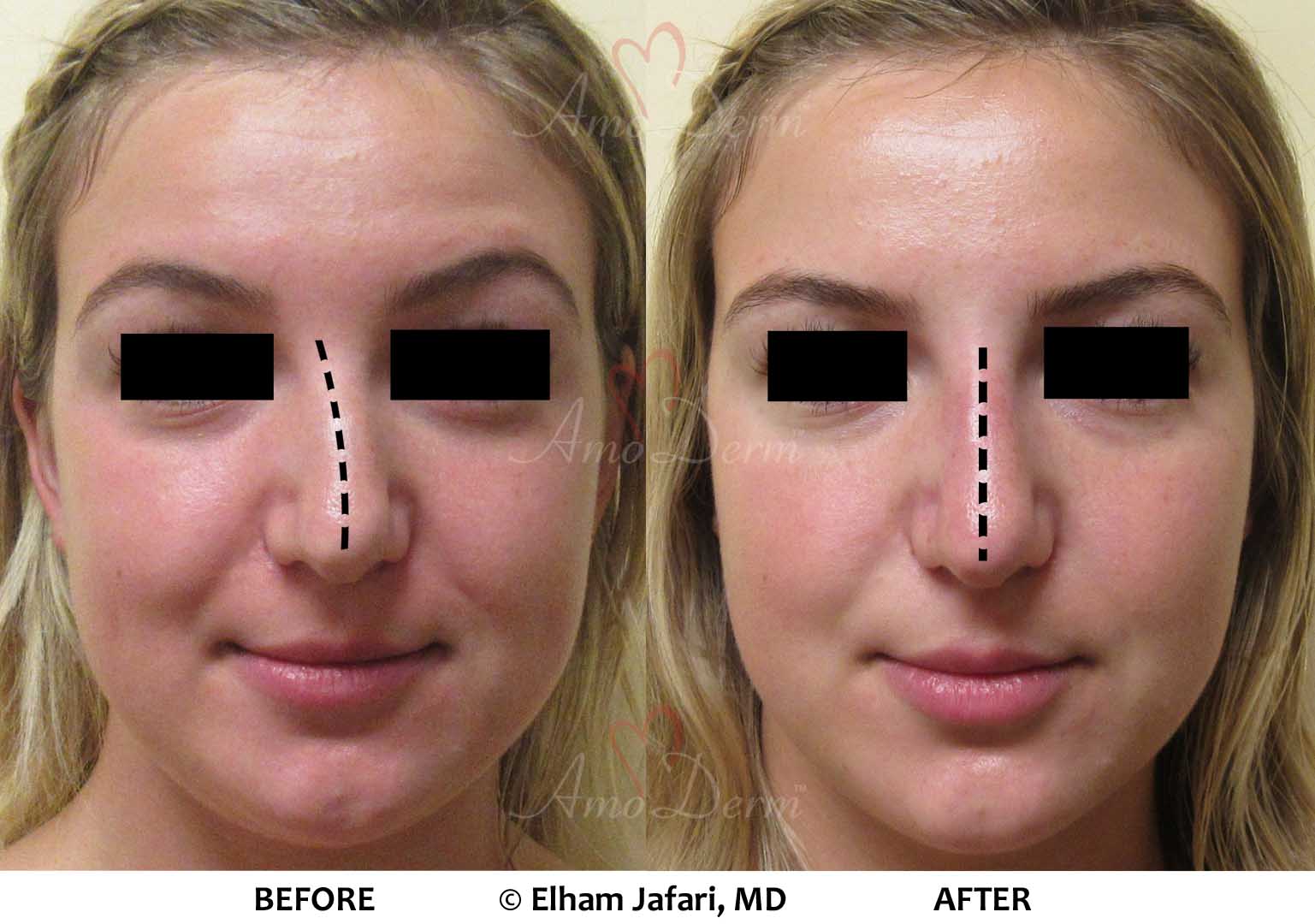 Nonsurgical Nose Job