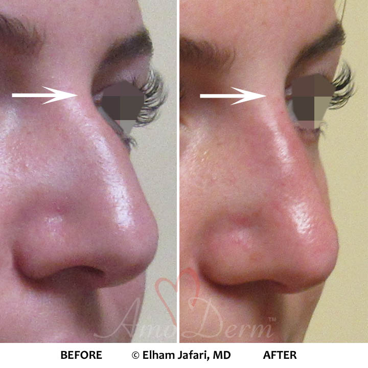 Nonsurgical Nose Job