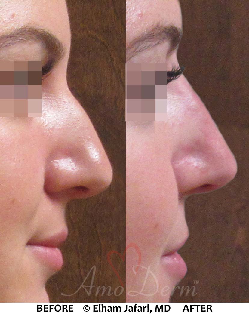 Nonsurgical Nose Job