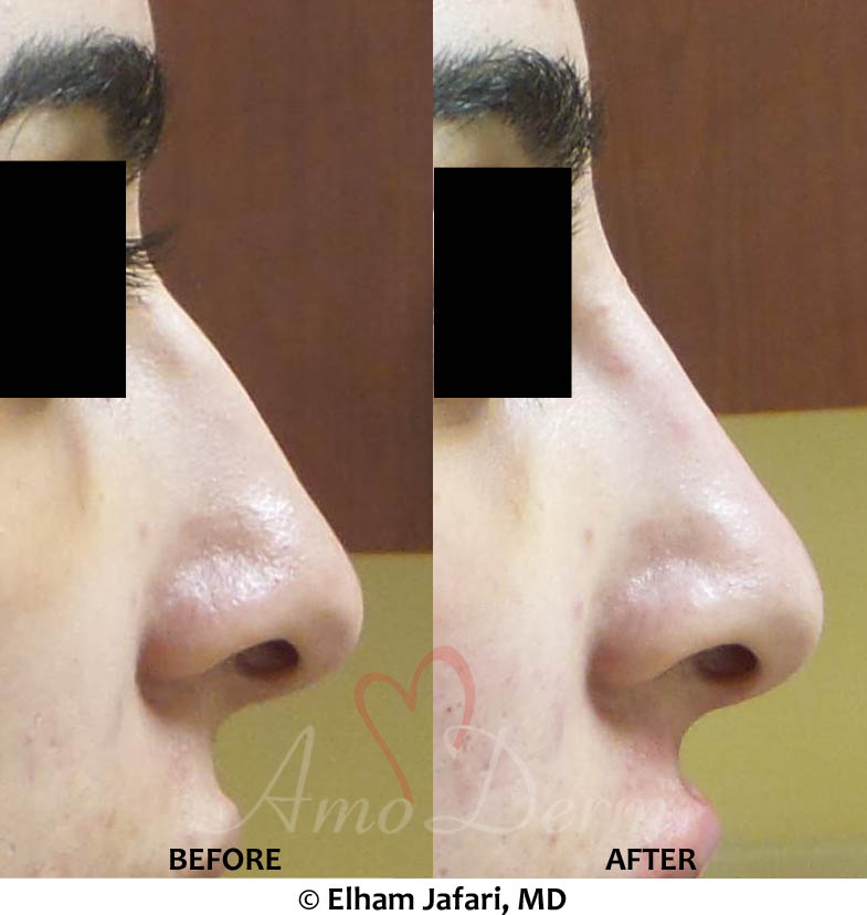 Nonsurgical Nose job