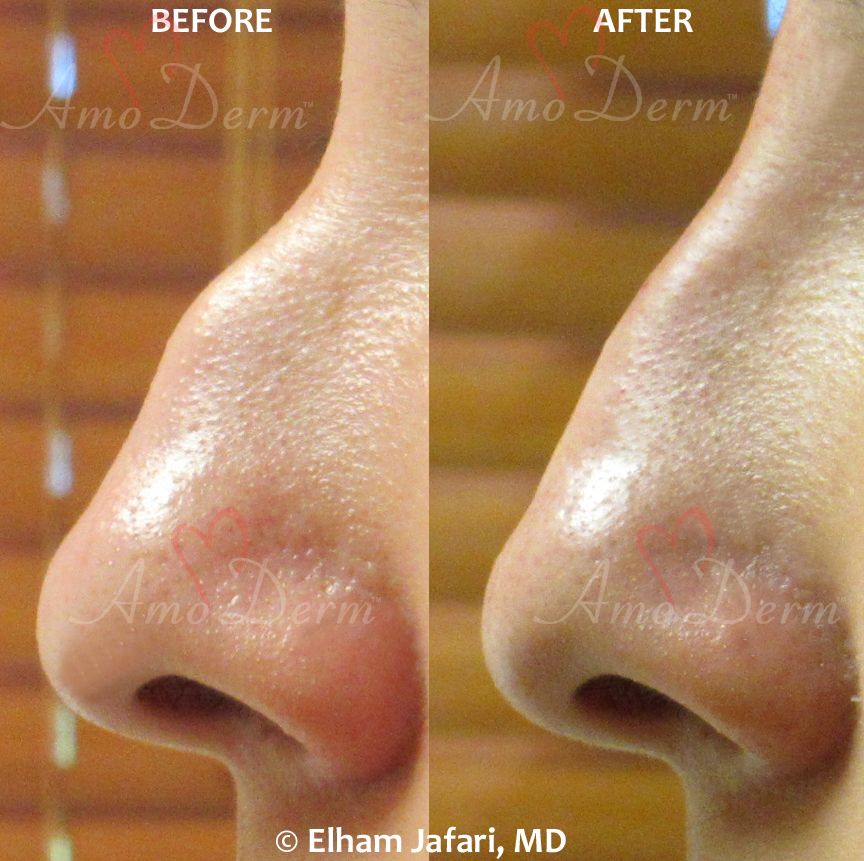 Non-surgical Nose Job Cosmetic Treatments Before and After Pictures