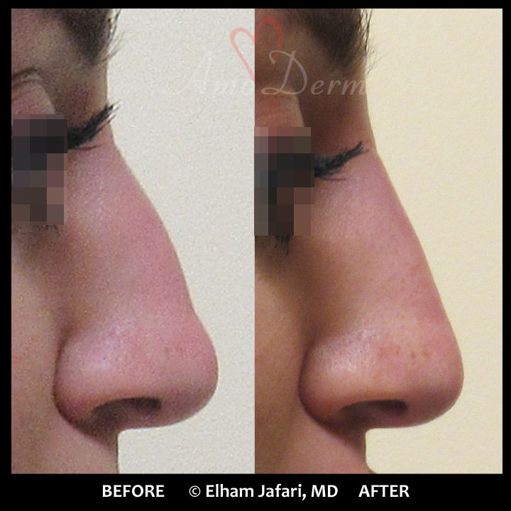 Non-surgical Nose Job