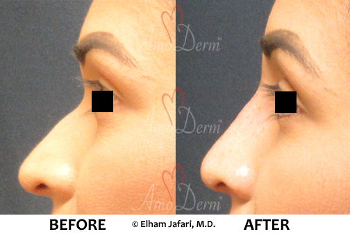 Nonsurgical nose job - Amoderm : Before & After Gallery