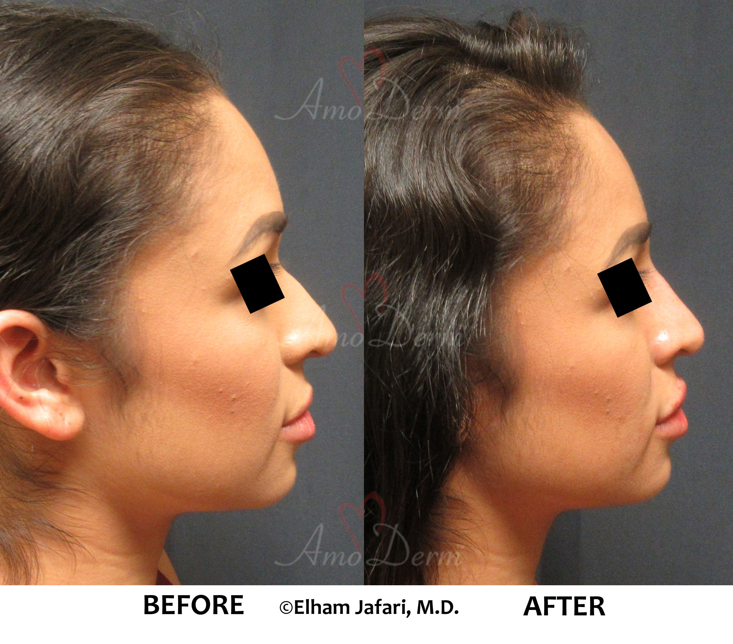 nonsurgical nose job - Amoderm : Before & After Gallery