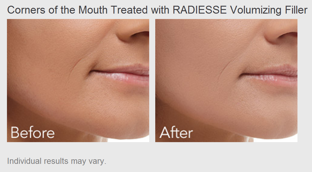 Corners of the Mouth treated with Radiesse Volumizing Filler - Before and After Photos