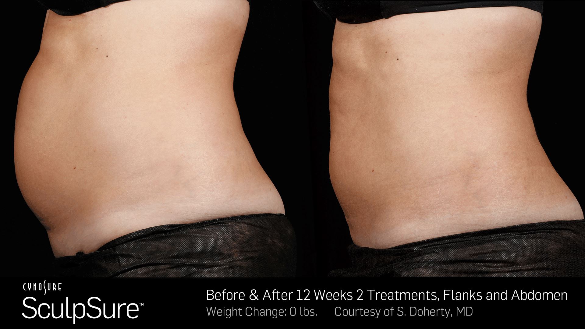 SculpSure - Before and After 12 weeks 2 treatments, Flanks and Abdomen
