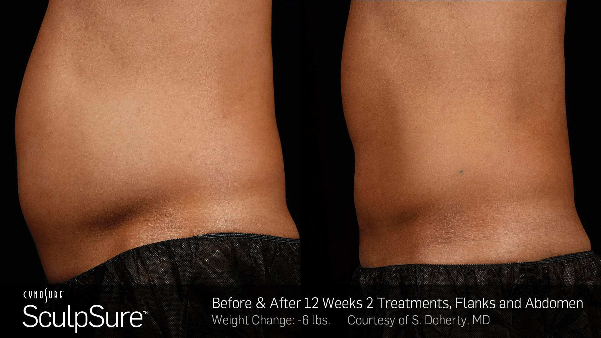 SculpSure - Who Is a Good Candidate for SculpSure?