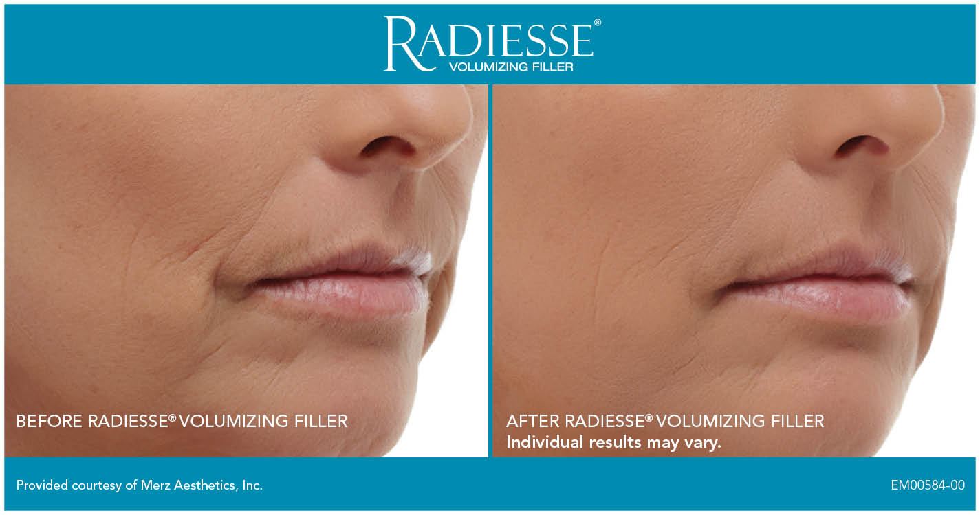Radiesse Treatment