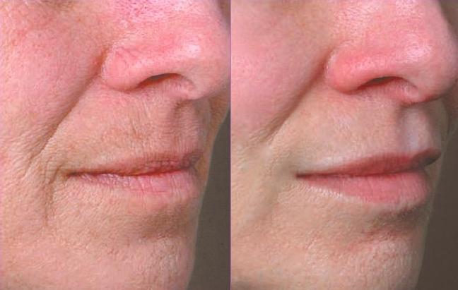 Volbella lips smokers lines