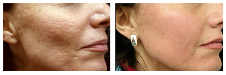 acne scars treatments - before and after pictures