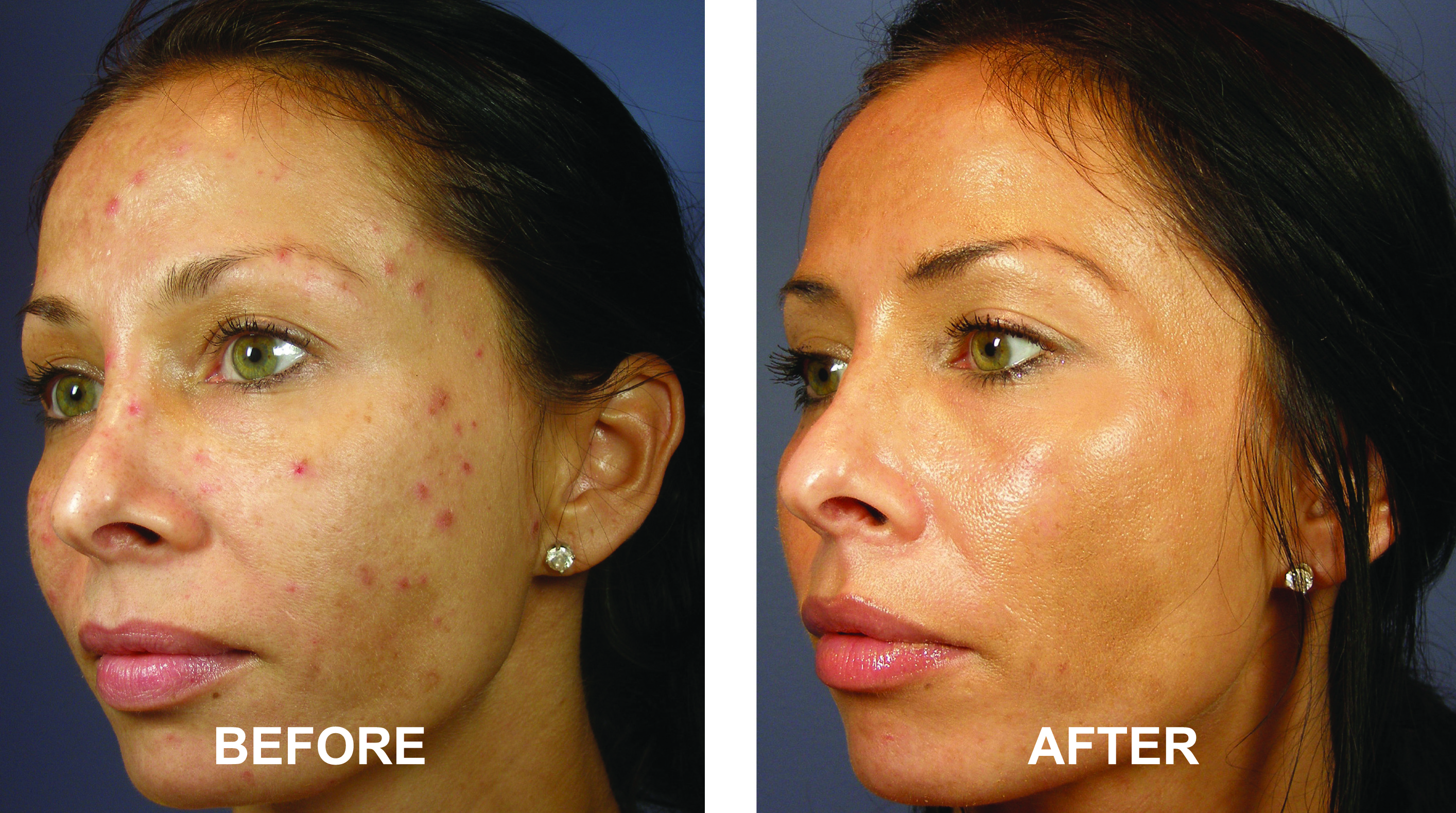 Irvine VI Peel - Newport Beach VI Peel - Orange County Acne Treatment