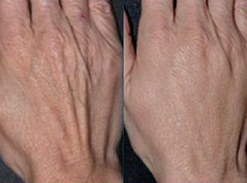 hand rejuvenation