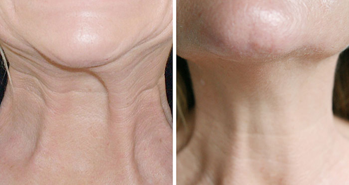 Neck Rejuvenation and Non-surgical Neck Lift
